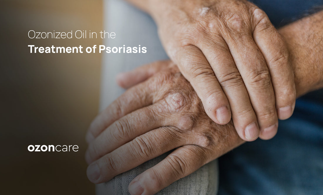 Ozonized Oil in the Treatment of Psoriasis